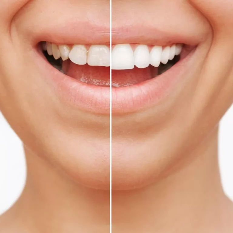 Dental veneers procedure in dubai for a stunning smile transformation