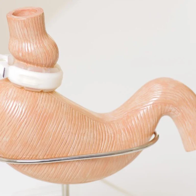 Gastric band surgery in dubai for effective weight loss by expert surgeons