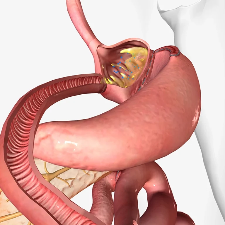 Gastric bypass surgery in dubai for effective weight loss performed by expert surgeons