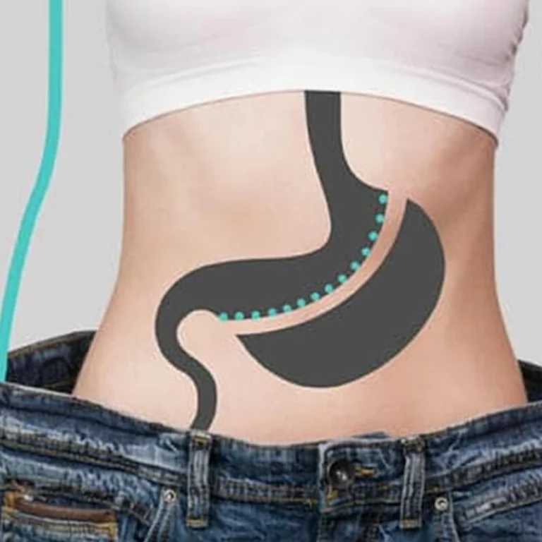 Gastric sleeve surgery in dubai