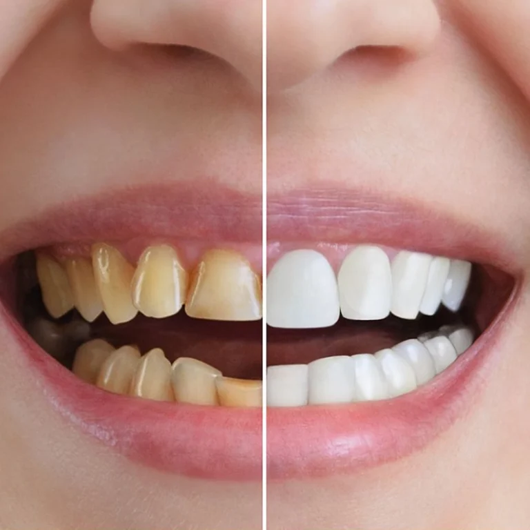 Professional teeth whitening procedure in Dubai for a brighter smile